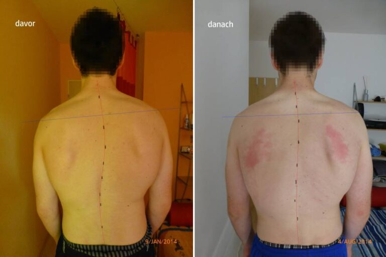 Vorher-Nachher-Bild eines Patienten nach einer Skoliose-Behandlung bei Physio Aktiv Reckendorf